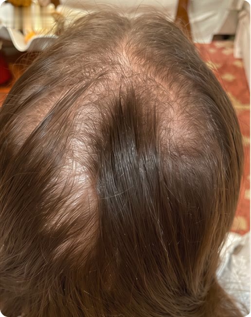 Risca do cabelo antes do protocolo