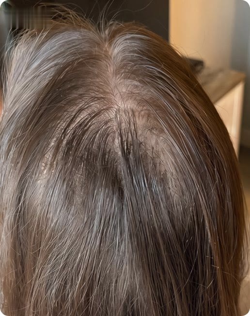 Risca do cabelo após 90 dias